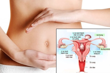 5 Tips to Preventing the Spread of Vaginal Thrush