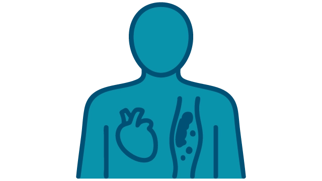 Atherosclerosis image